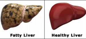 Bahaya Penyakit Fatty liver